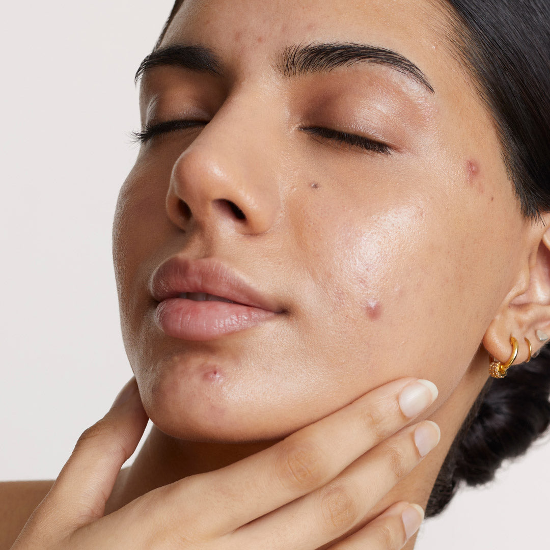 How to get rid of acne marks fast!