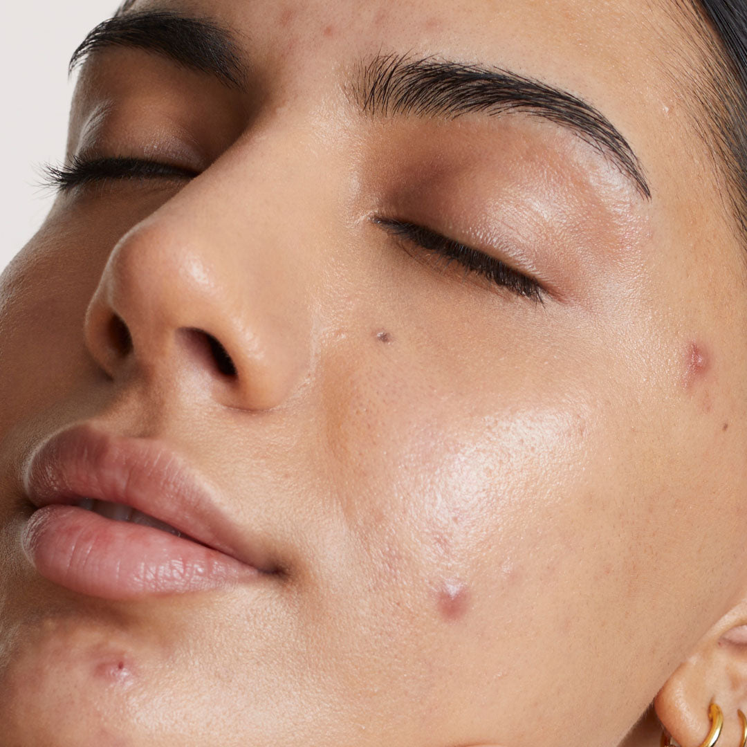 How to get rid of acne marks fast!