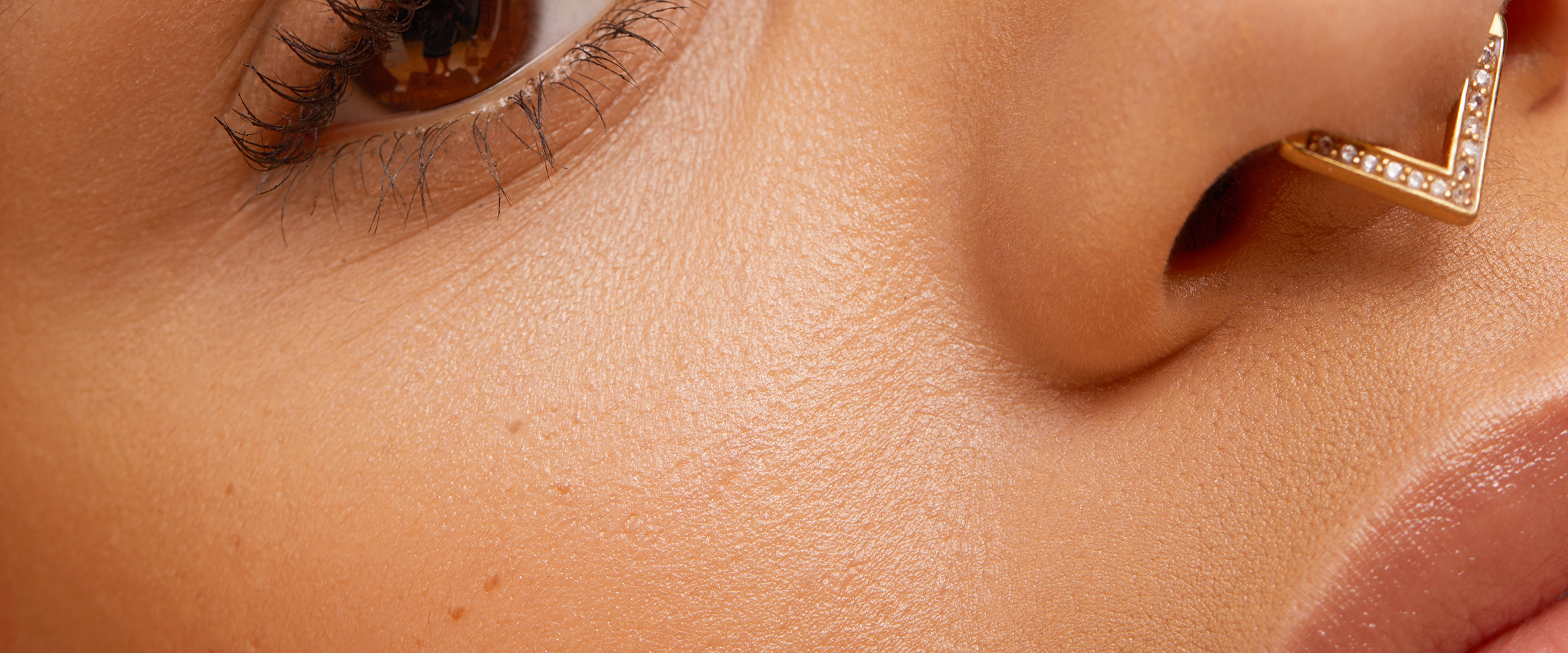Hyperpigmentation