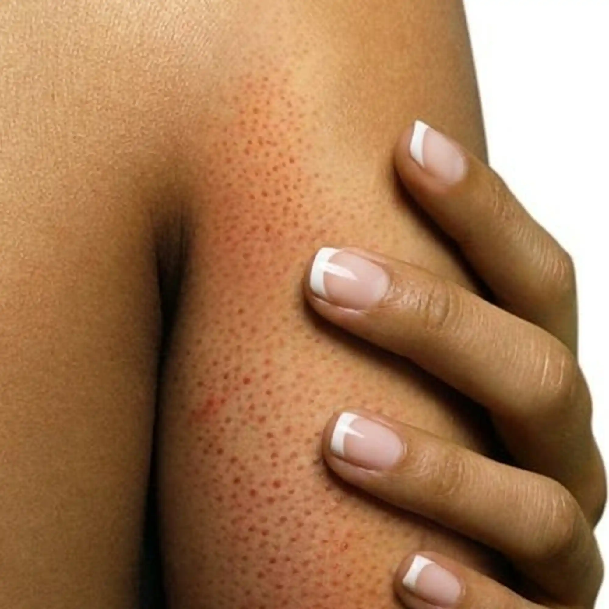 Chicken Skin in Indian Skin: Causes, Treatment & Routine – Boofootel