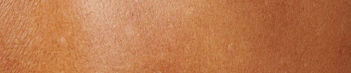 Dehydrated skin showing dullness, tightness and visible fine dehydration lines.