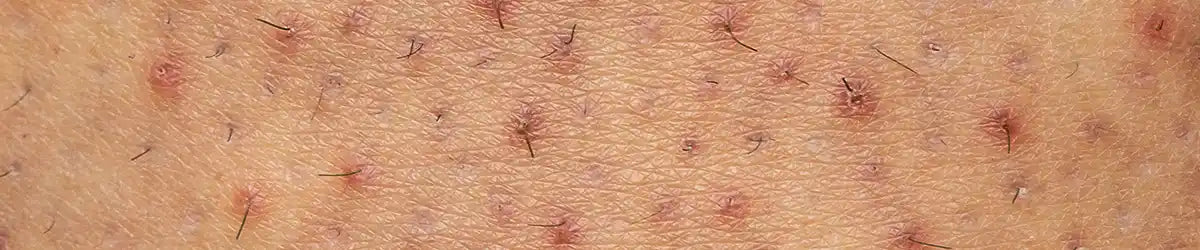 Ingrown hair and razor bumps on body skin after shaving or waxing.