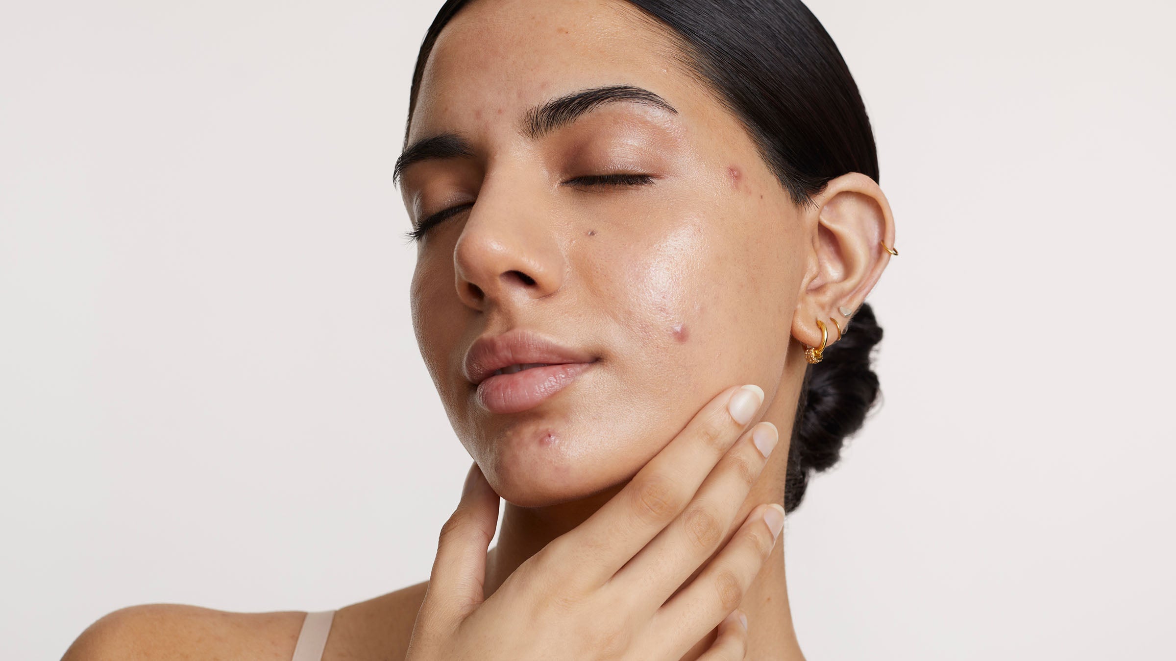 The brightening serum that actually fades post acne marks