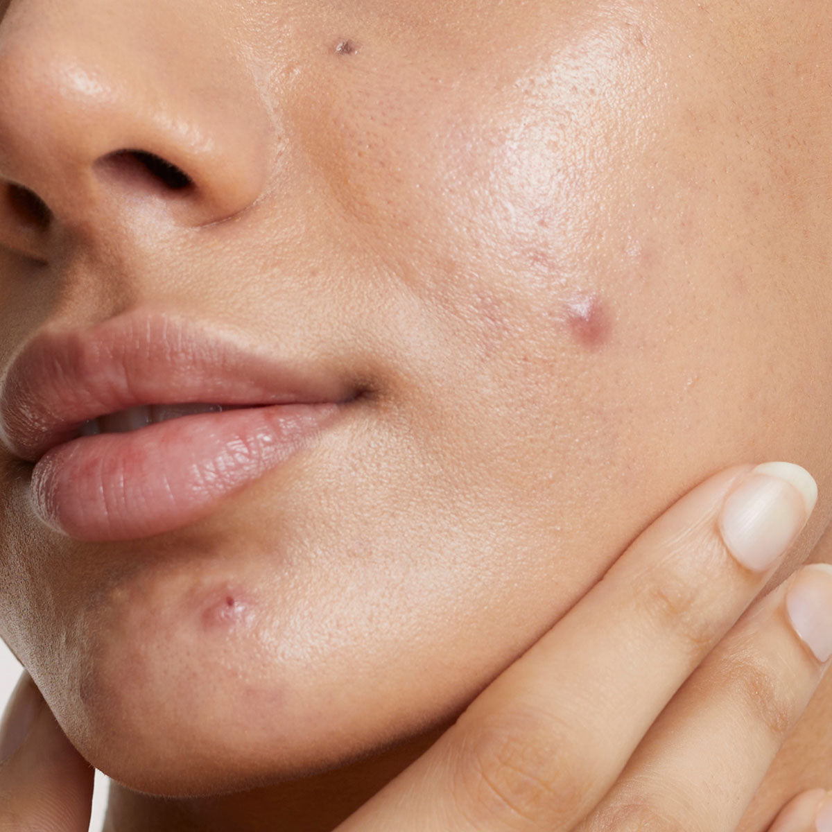 Boofootel Sooperboost face serum fades acne marks and clears skin