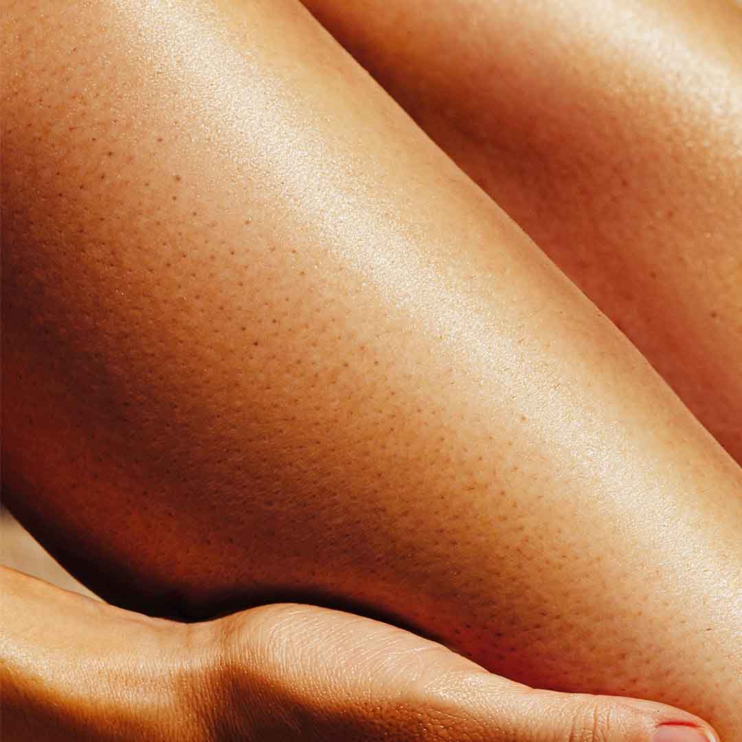 Strawberry Skin. The Full Indian Skin Guide to Causes, Treatments & Prevention.
