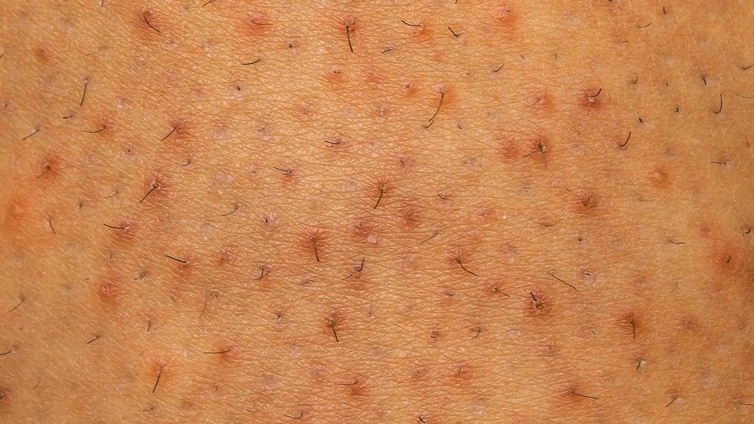 Boofootel Soopersmooth Body serum smoothens and clears strawberry skin, ingrown hair, clogged hair follicles, KP, bumps