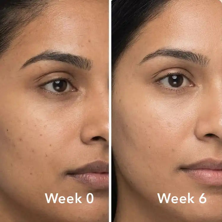 Before and after results showing visibly smoother, brighter skin after 6 weeks of using Sooperboost serum — Week 0 vs Week 6 comparison