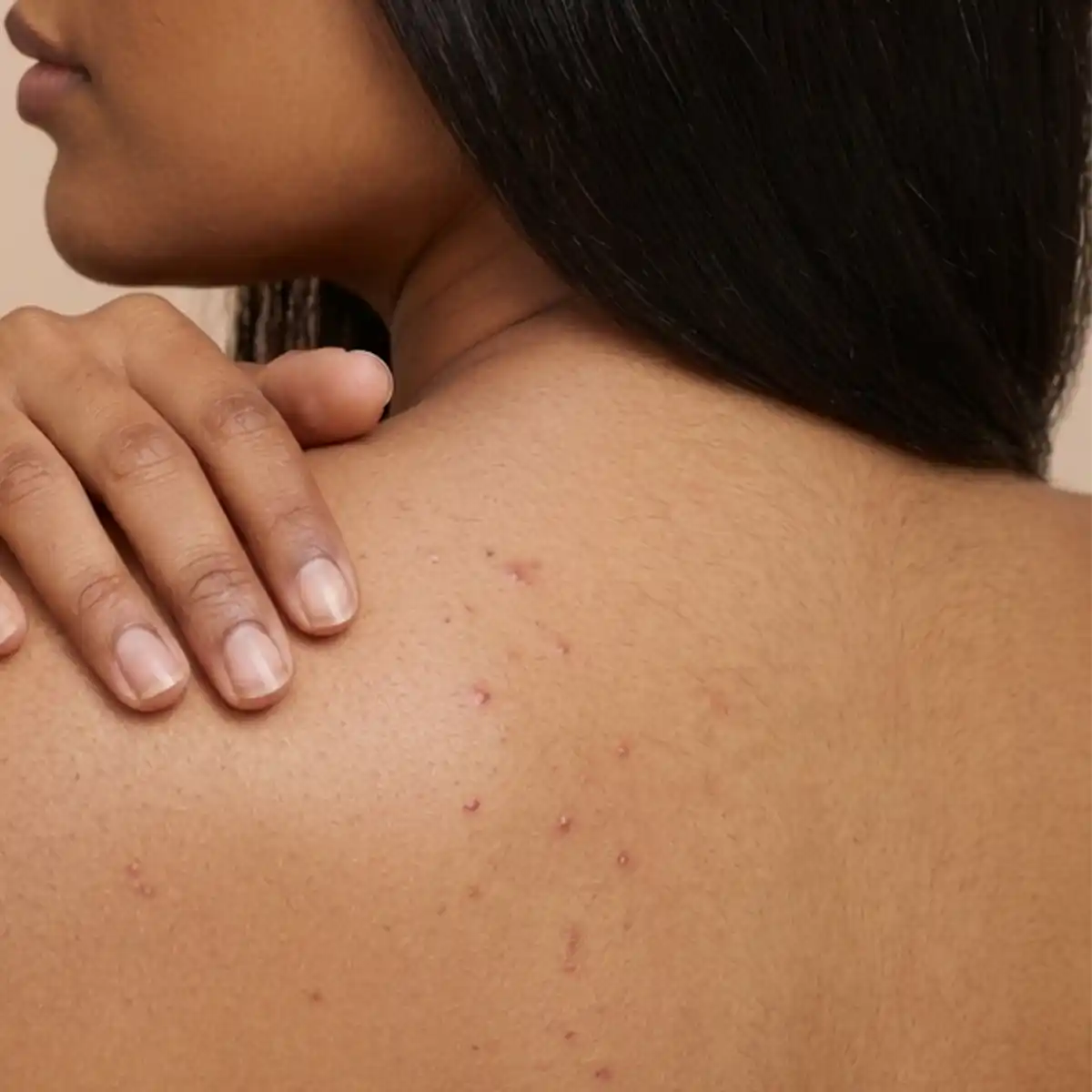Body acne, back acne and bum acne on Indian skin. Boofootel Soopersmooth body serum with Glycolic Acid, Lactic Acid, Niacinamide and Vitamin C helps unclog pores, calm skin and fade acne marks.