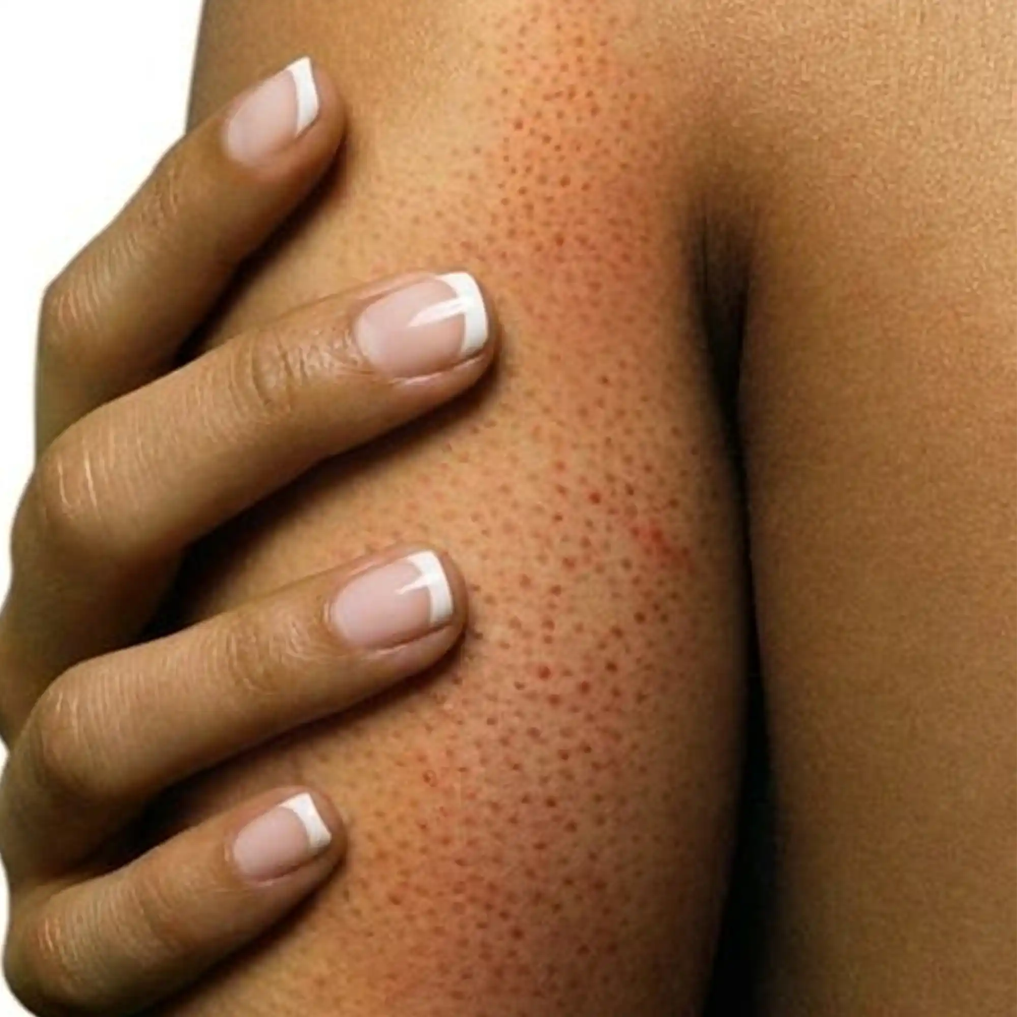 Bumpy skin on Indian skin caused by clogged hair follicles on arms, thighs and bum. Boofootel Soopersmooth body serum with Glycolic Acid, Lactic Acid, Vitamin C and Niacinamide exfoliates, smooths texture, brightens dark spots and hydrates skin.