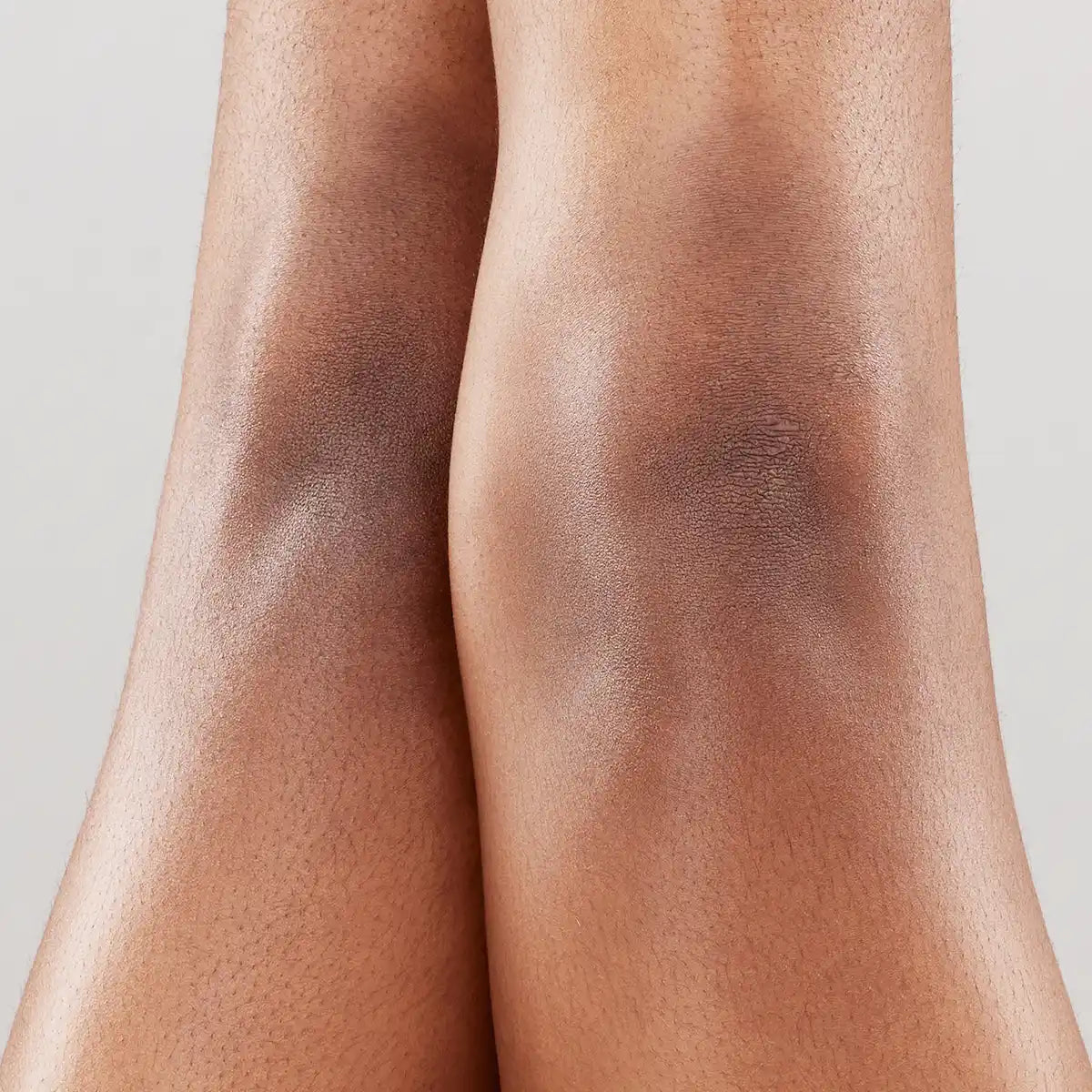 Dark knees and body pigmentation on Indian skin. Boofootel Soopersmooth body serum with Glycolic Acid, Vitamin C and Niacinamide helps brighten dark spots, fade pigmentation and even skin tone.