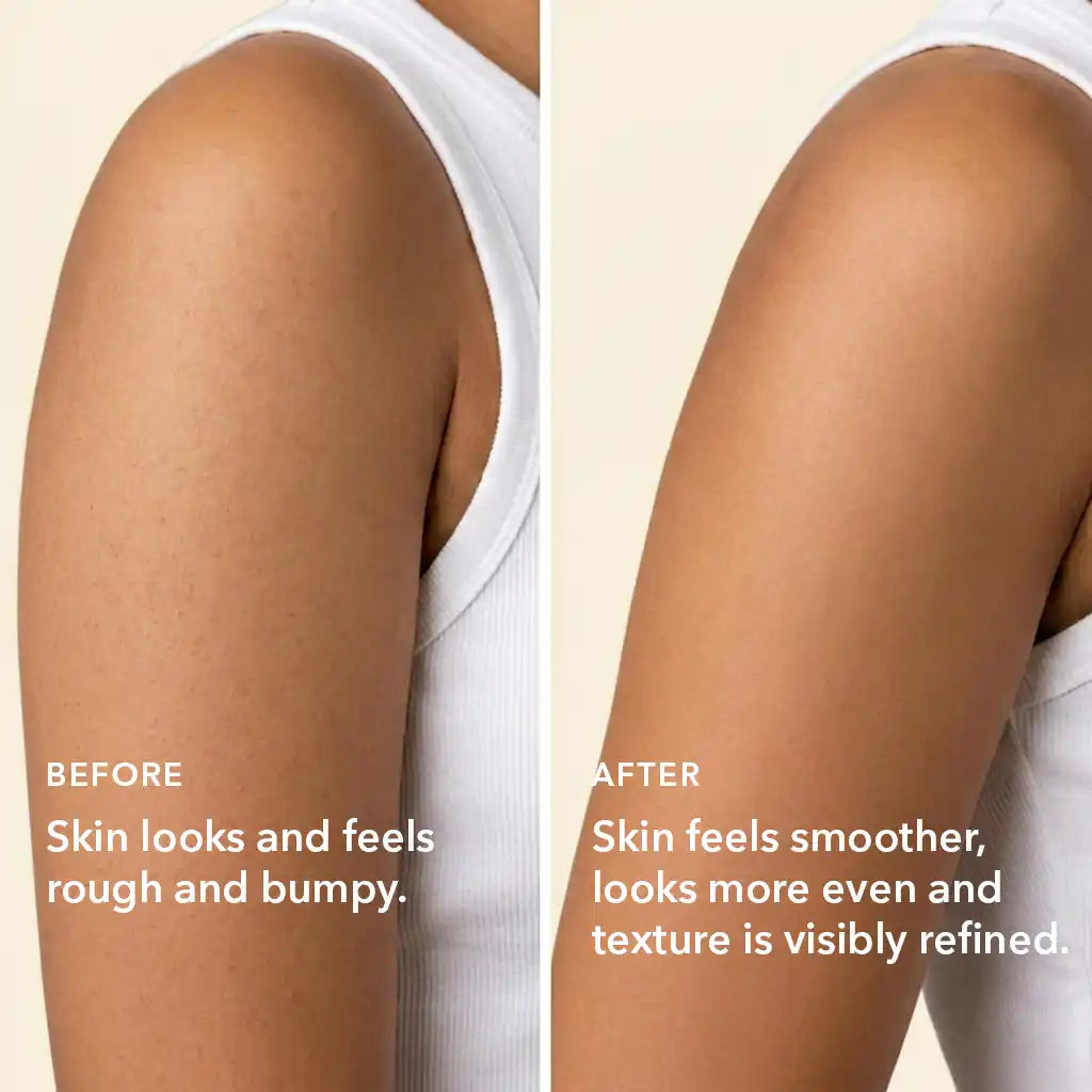 Before and after showing smoother skin texture on arms with reduced keratosis pilaris using Boofootel body serum