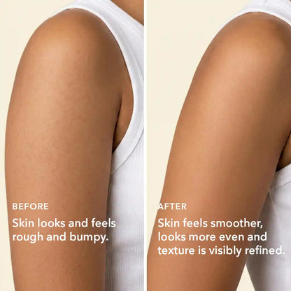 Before and after showing smoother skin texture on arms with reduced keratosis pilaris using Boofootel body serum
