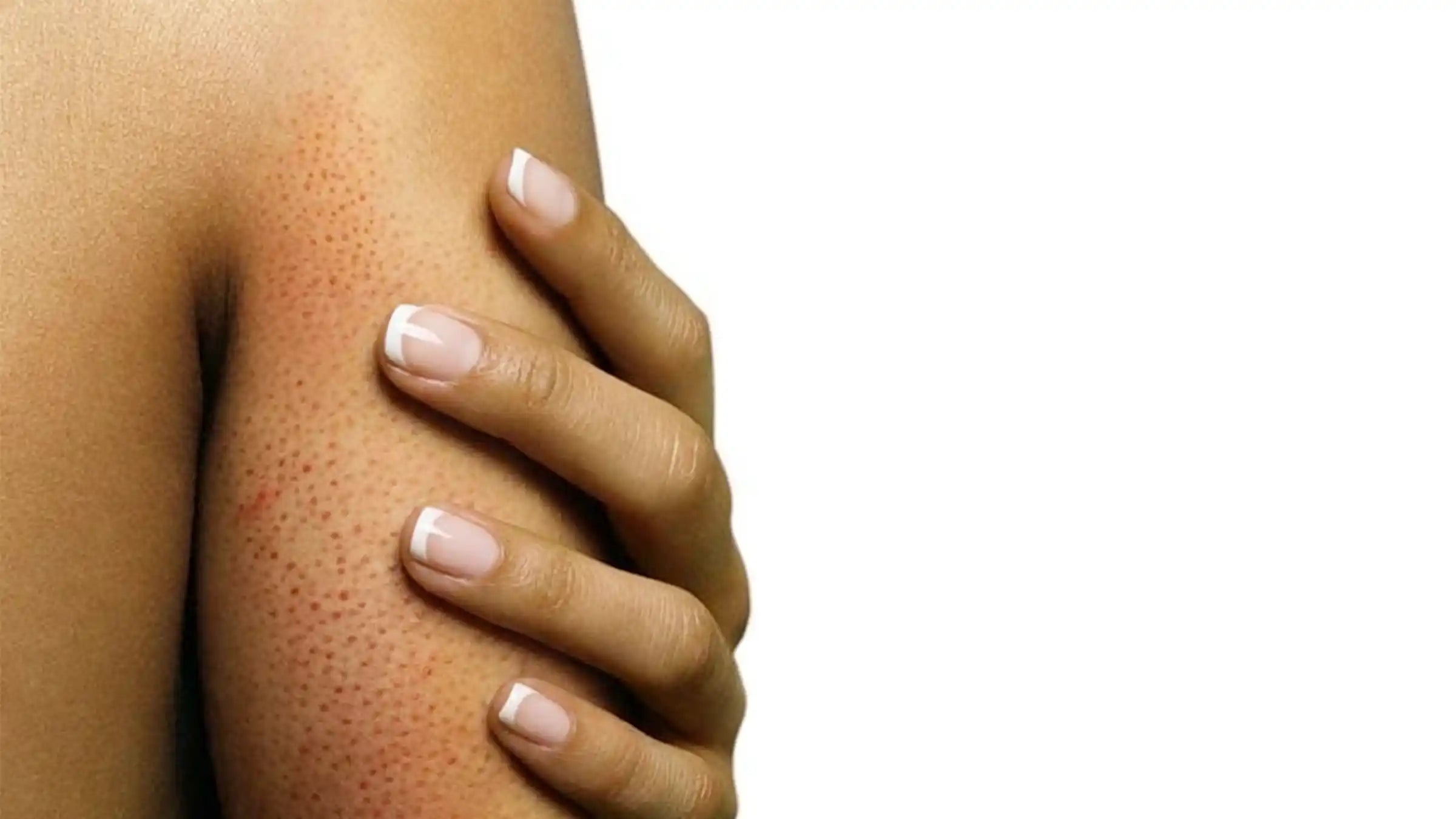 Close-up of Indian arms with chicken skin showing rough and bumpy texture, illustrating keratosis pilaris and treatment options